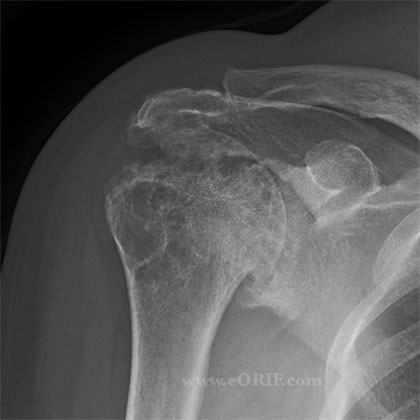 Rotator cuff arthropathy X-ray