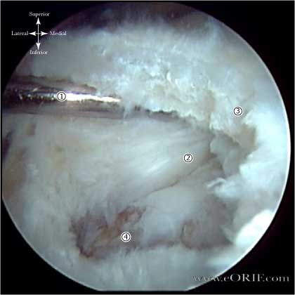 RTC tear image Crescent shaped RTC tear image