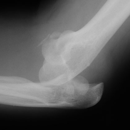 type IV radial head fracture image type IV radial head fracture