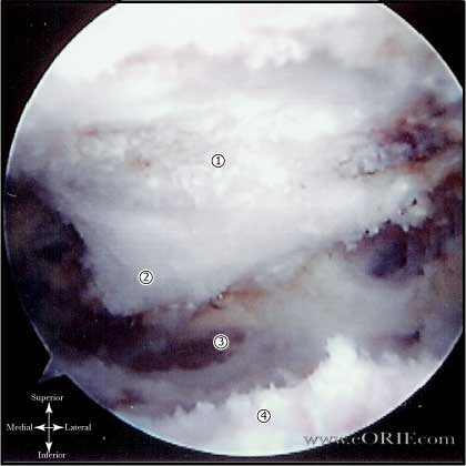 Type III acromion Type III acromion picture