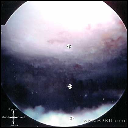 Arthroscopic SAD Arthroscopic subacromial decompression