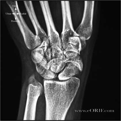 Scaphoid nonunion xray Scaphoid fracture nonunion xray