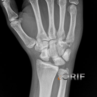 Scapholunate ligament tear