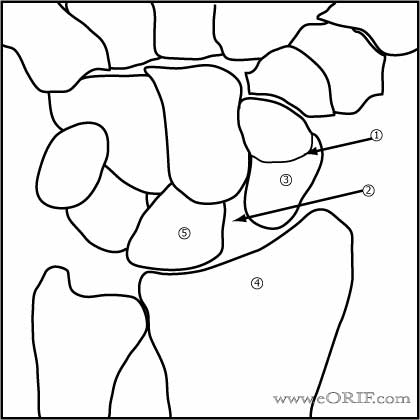 Wrist instability image Wrist instability image
