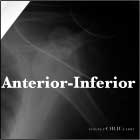 anterior inferior shoulder dislocation
