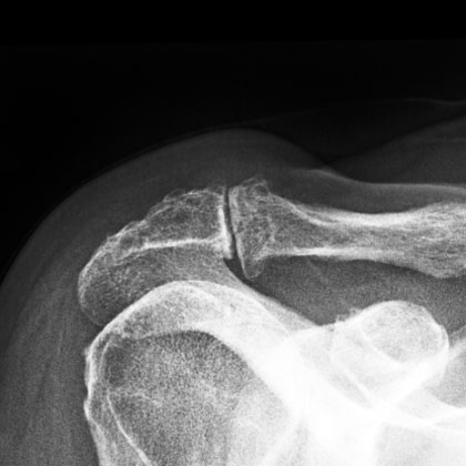 AC arthritis xray AC arthritis xray