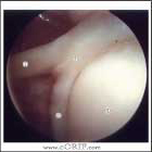 normal biceps labral complex arthroscopy normal biceps labral complex arthroscopy