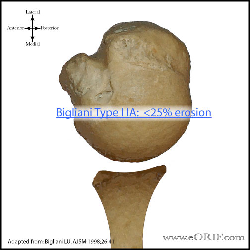 type 3a bony bankart picture type 3a bony bankart picture