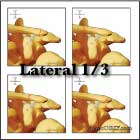 Distal clavicle fracture Distal clavicle fracture