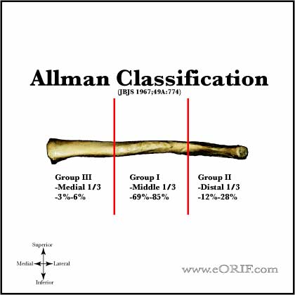 Allman Classification Allman clavicle fracture classification