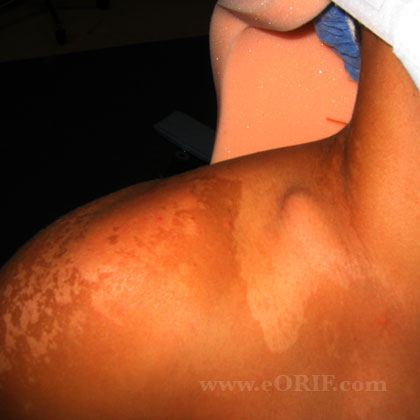 Clavicle fracture clinical photo Clavicle fracture clinical photo