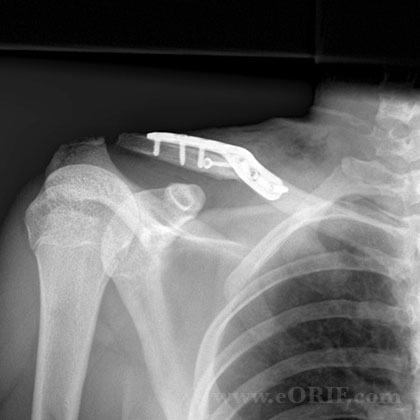 Clavicle fracture ORIF xray Clavicle fracture ORIF xray