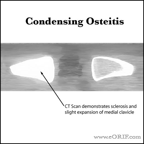 Condensing Osteitis Condensing Osteitis image