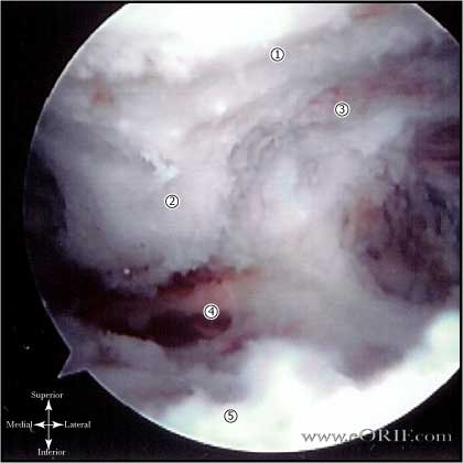 Arthroscopic SAD Arthroscopic subacromial decompression