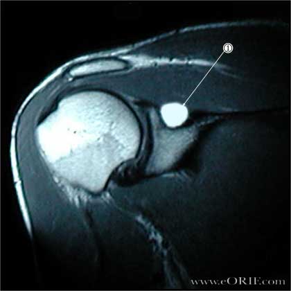 Suprascapular Neuropathy Images suprascapular-neuropathy-images