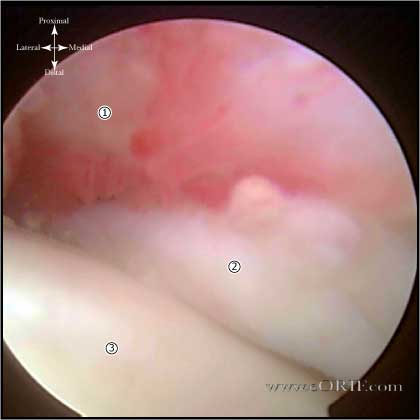 adhseive capsulitis picture adhesive capsulitis picture