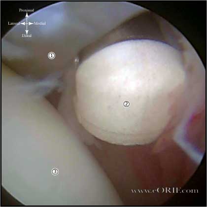 rotator interval release picture rotator interval release picture