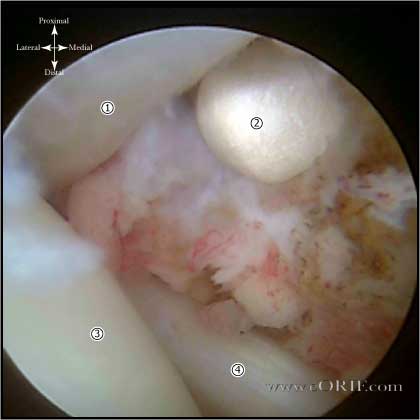 rotator interval release picture rotator interval release picture