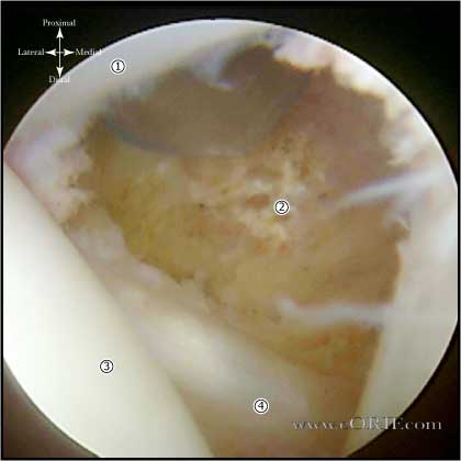 rotator interval release picture rotator interval release picture