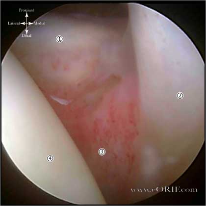 adhseive capsulitis picture adhesive capsulitis picture