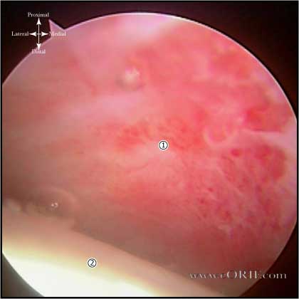 adhseive capsulitis picture adhesive capsulitis picture