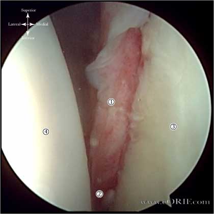 bankart lesion pictue bankart lesion picture