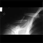 Clavicle fracture xray Clavicle fracture xray