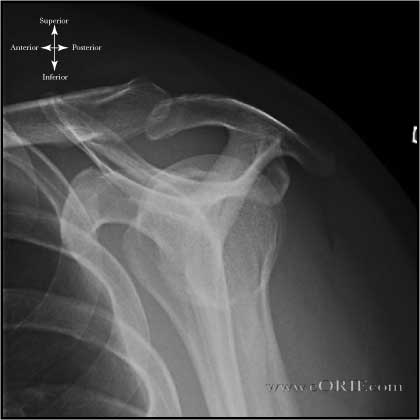 Supraspinatus Outlet view Shoulder Xray Supraspinatus Outlet view Shoulder Xray