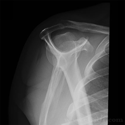 Scapular Y Shoulder Xray Scapular Y Shoulder Xray