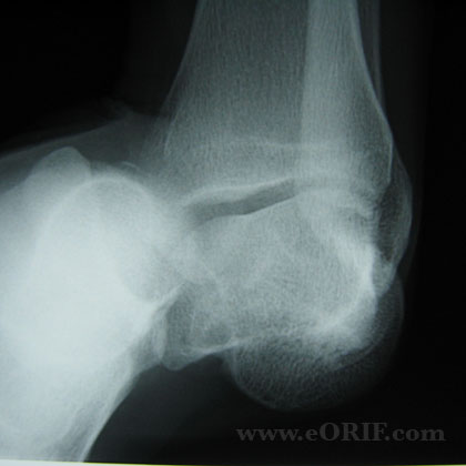 Subtalar dislocation xray Subtalar dislocation xray image