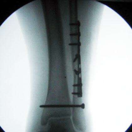 Lateral malleolus fracture ORIF xray Lateral Malleolus fracture ORIF xray operative fixation