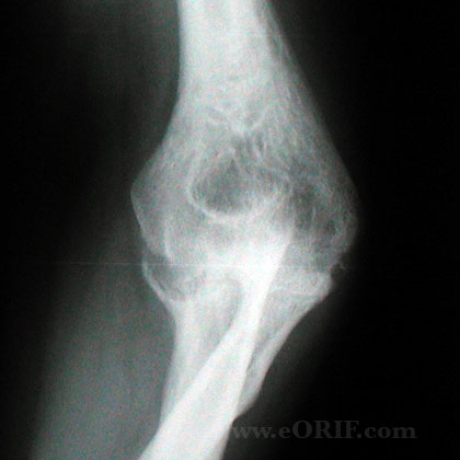 elbow arthritis xray elbow arthritis xray
