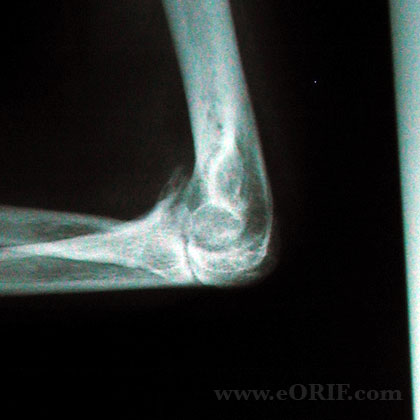 elbow arthritis xray elbow arthritis xray