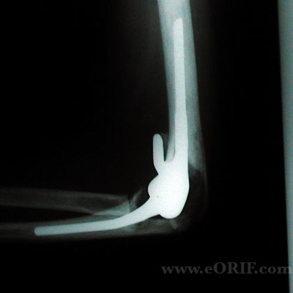 total elbow replacement xray total elbow arthroplasty xray