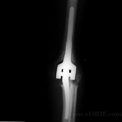 total elbow replacement xray picture total elbow arthroplasty xray