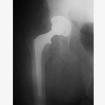 THA for AVN xray THA for AVN xray