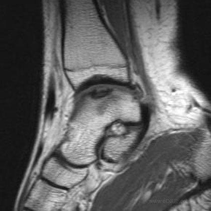 Talus OCD CT Talus OCD CT scan image