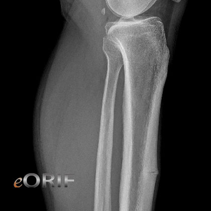 Tibial stress fracture xray
