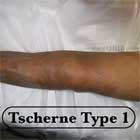 Tsherne Type I soft tissue injury image