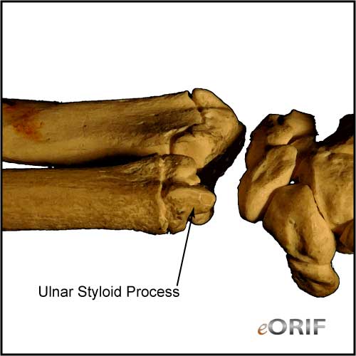ulmar styloid process ulnar styloid process