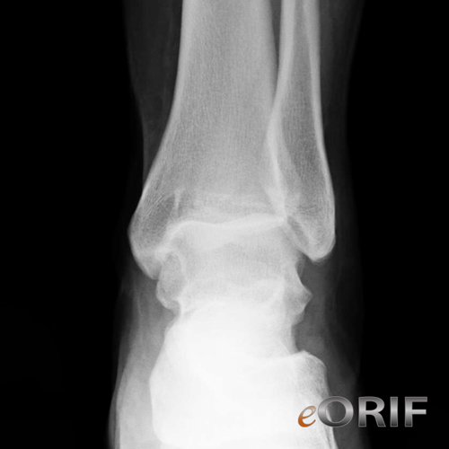 ankle dislocation xray ankle dislocation xray