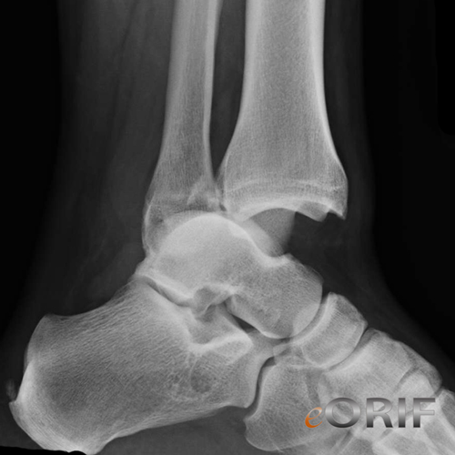 ankle dislocation xray ankle dislocation xray
