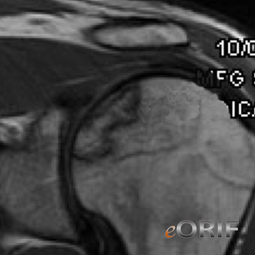 humeral head avascular necrosis mri avascular necrosis humerus mri