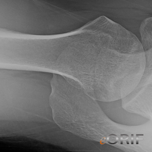 humeral head avascular necrosis xray avascular necrosis humerus xray