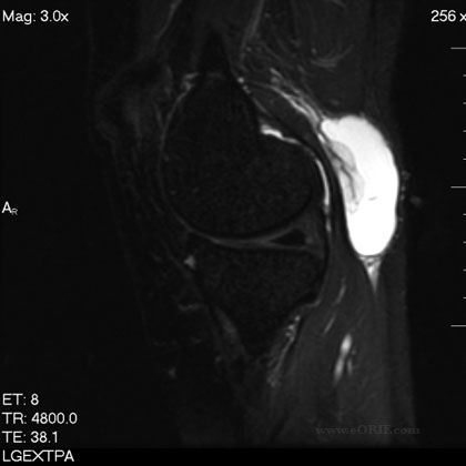 bakers cyst mri Bakers cyst MRI