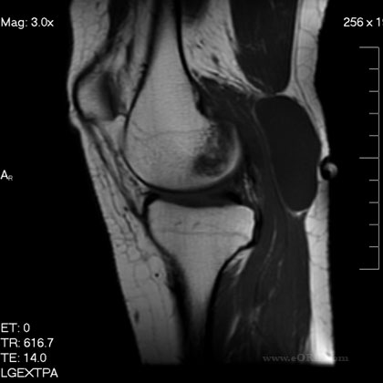 bakers cyst mri Bakers cyst MRI