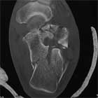 Calcaneus fracture image Calcaneus fracture CT scan image