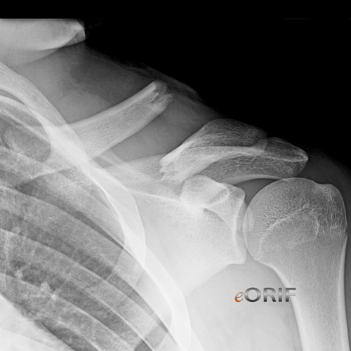 clavicle fracture sonoma nail