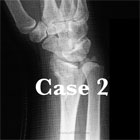 Distal radius fracture xray Distal radius fracture A/P xray