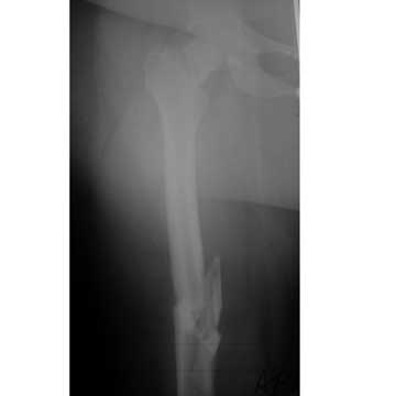 Femoral neck and shaft fracture xray Femoral neck-shaft fracture xray
